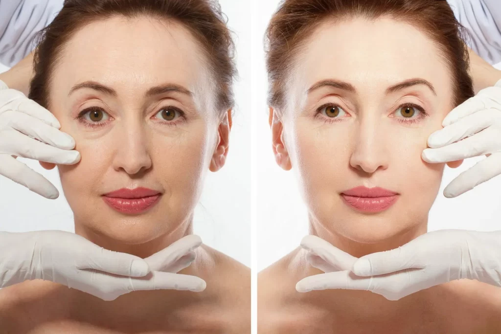 Mini Face Lift Scaled 1 - Özel Medlook Polikliniği