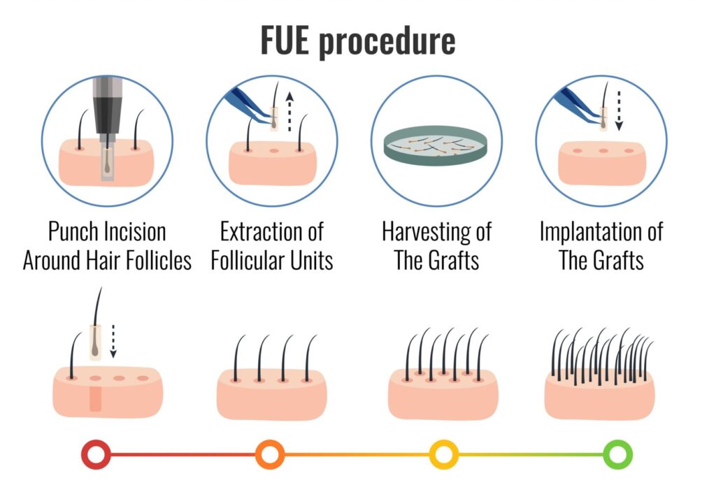 Comment se déroule la greffe de cheveux Fue ?