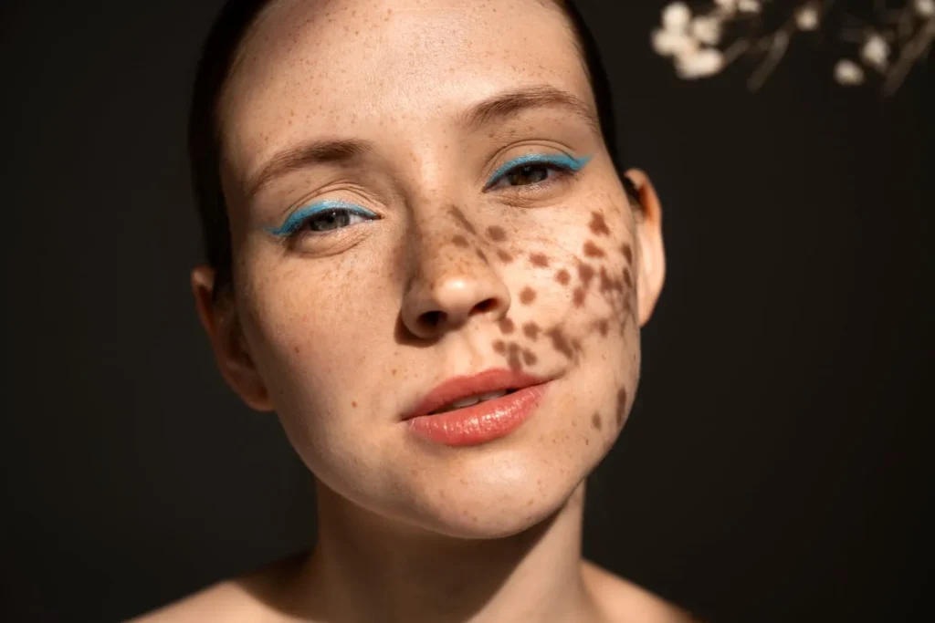 Causes of Skin Blemishes, Types, Causes and Treatment Options 1 - Özel Medlook Polikliniği