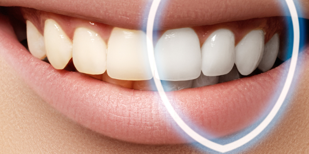 Le blanchiment des dents endommage-t-il l'émail dentaire ? Approches scientifiques actuelles %Sep% %Sitename%