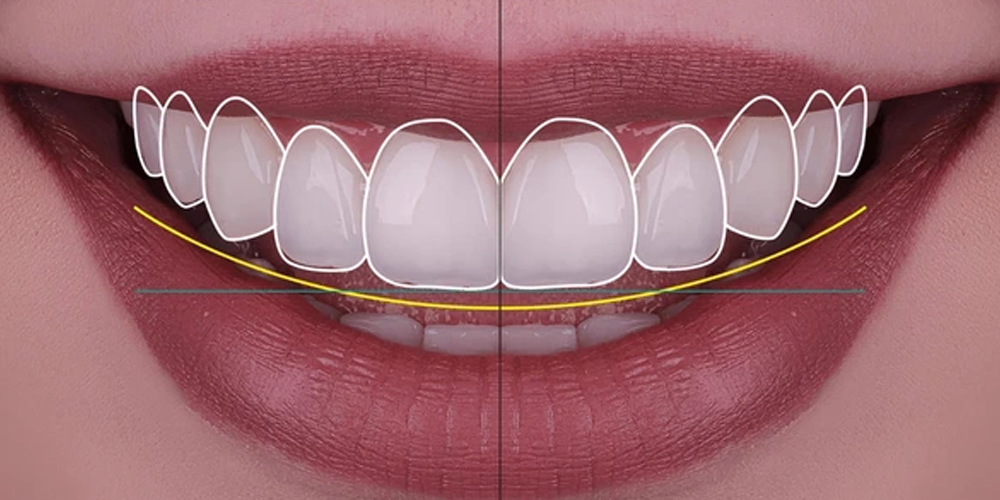 Digitales Lächeln-Design (DSD): Hollywood Smile im Voraus sehen %Sep% %Seitenname%