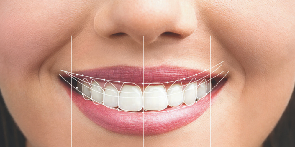 Digitales Lächeln-Design (DSD): Hollywood Smile im Voraus sehen %Sep% %Seitenname%