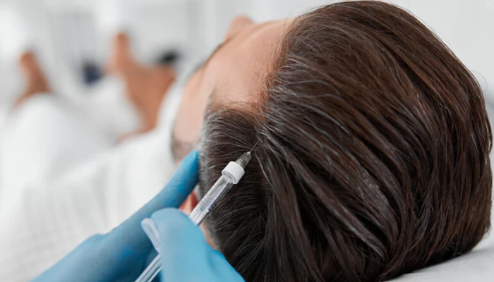 La mésothérapie pour stopper la chute des cheveux | Medlook