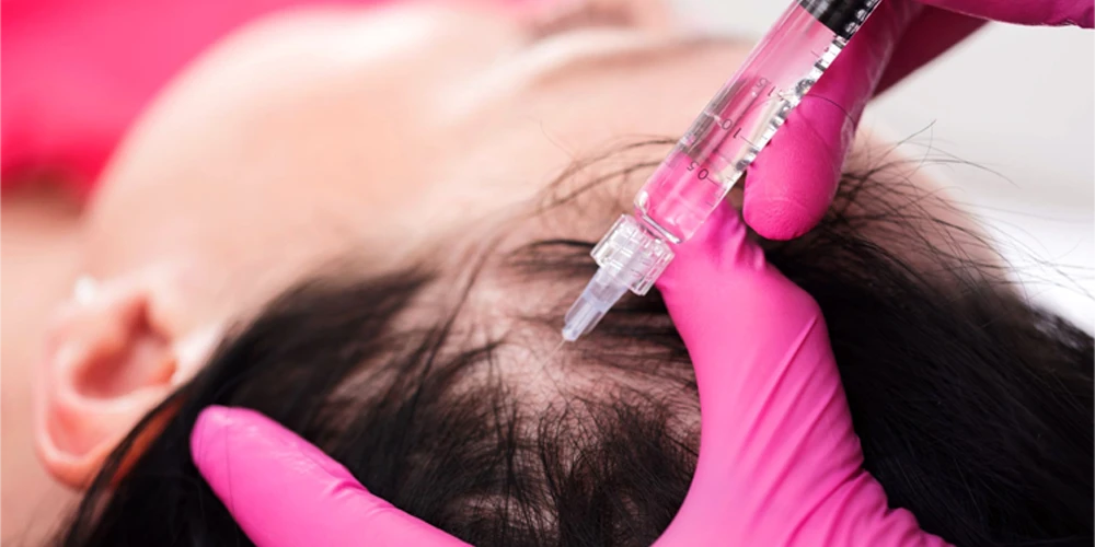 Hair Mesotherapy Sessions and Results