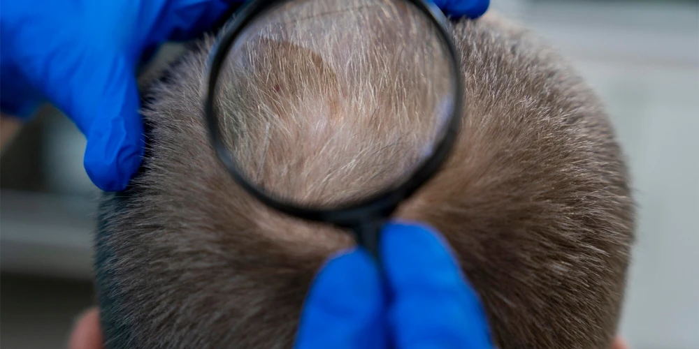 Androgenetik Alopesi Tedavisinde Saç Mezoterapisinin Rolü İstanbul