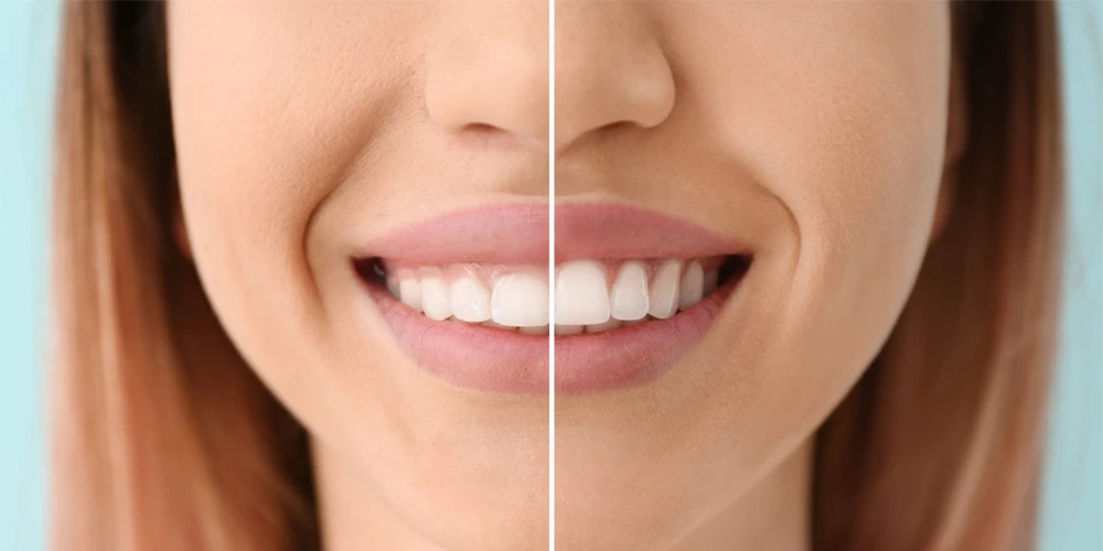 Gum Level Irregularities: Gingivectomy and Gingivoplasty
