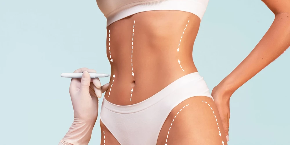 Coolsculpting, Lipolyse au laser, Lipolyse par injection