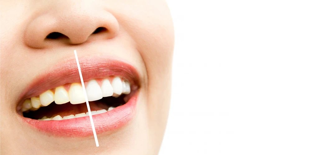 Comparison of Teeth Whitening Methods: For White Teeth