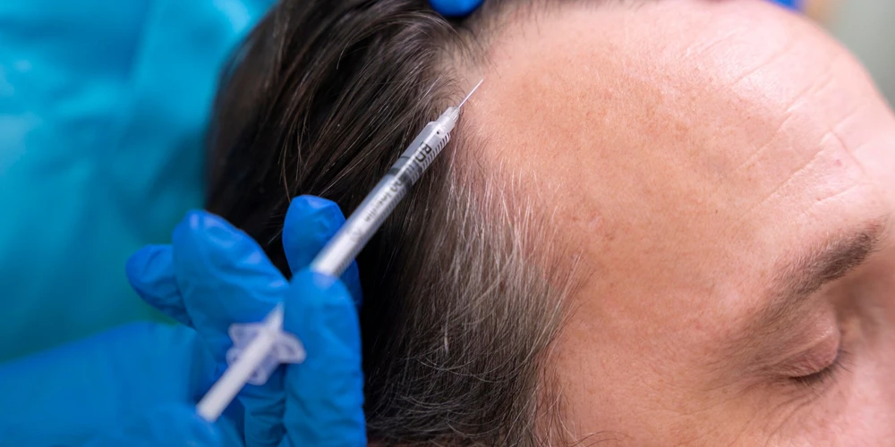 Capelli sani e rigogliosi con la mesoterapia per capelli