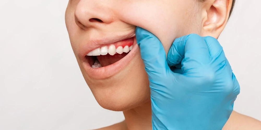 Pink Aesthetics (Gingival Aesthetics): Its Place in Smile Design for a Flawless Smile