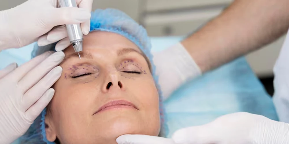 Blepharoplasty is a Surgical Solution for Sagging and Bagging Eyelids