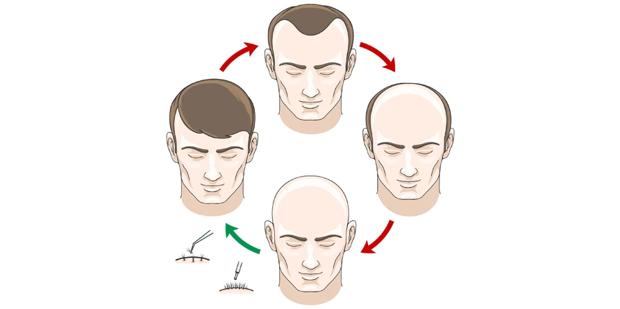 Trapianto di capelli a coda lunga