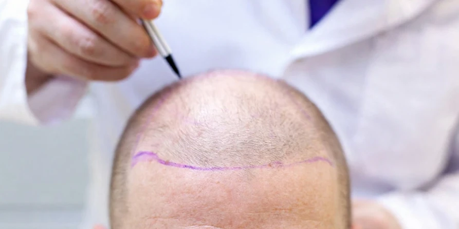 Trapianto di capelli a coda lunga