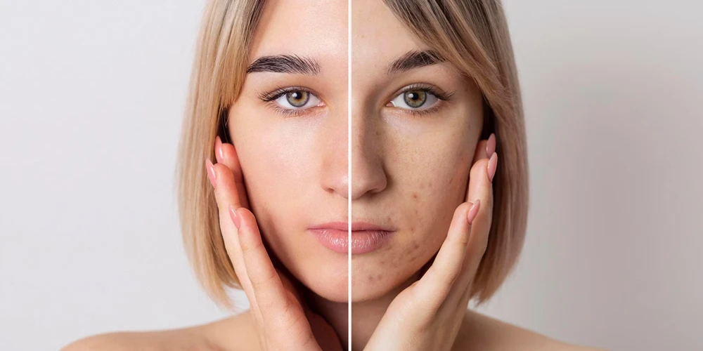 Gold Needle Effect in Pore Tightening Spot And Acne Scar Treatment3 - Private Medlook Polyclinic Gold Needle Effect in Pore Tightening Spot And Acne Scar Treatment3 - Private Medlook Polyclinic