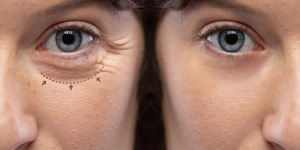 La chirurgia della palpebra superiore influisce sul campo visivo Processo di recupero funzionale e fatti scientifici2 - Özel Medlook Polikliniği La chirurgia della palpebra superiore influisce sul campo visivo Processo di recupero funzionale e fatti scientifici2 - Özel Medlook Polikliniği