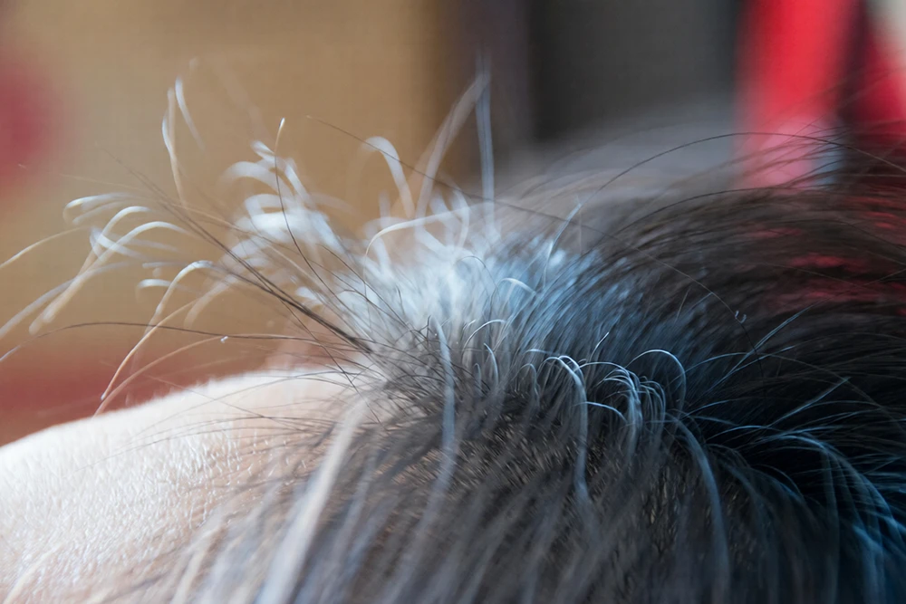 Long Hair Fue (Long Hair Transplant): Don't wait for the result, experience it instantly