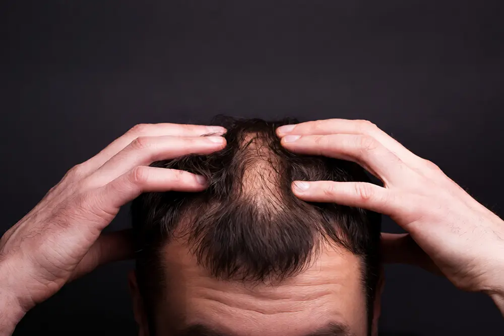Perdita di capelli: Cause biologiche, diagnosi clinica e protocolli di trattamento olistico