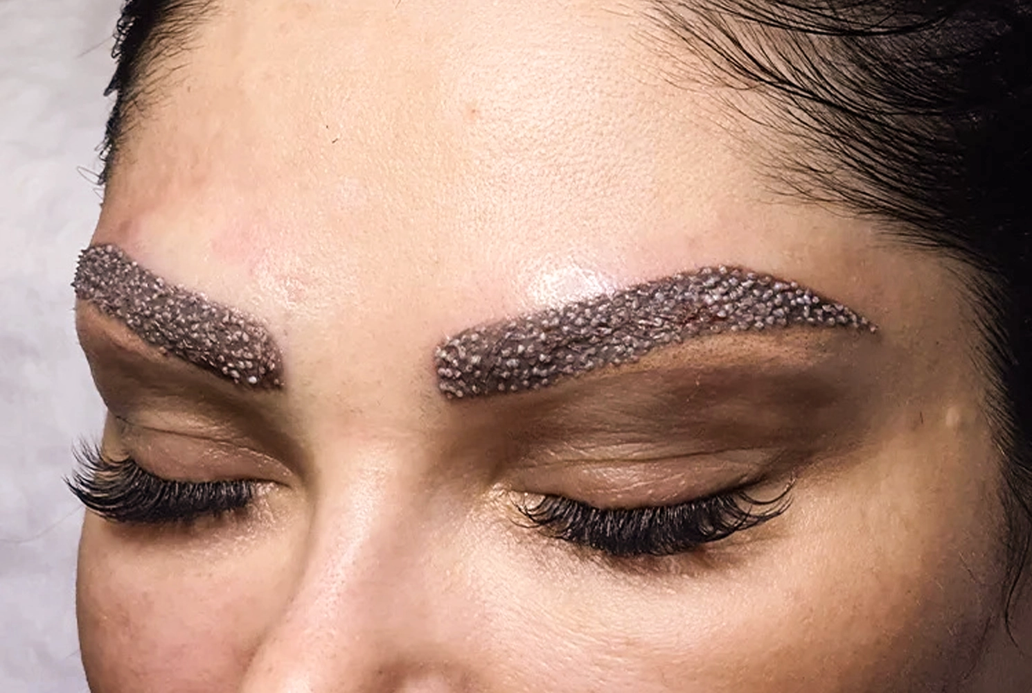 Comment se fait la transplantation de sourcils ? Etapes et processus technique | Medlook