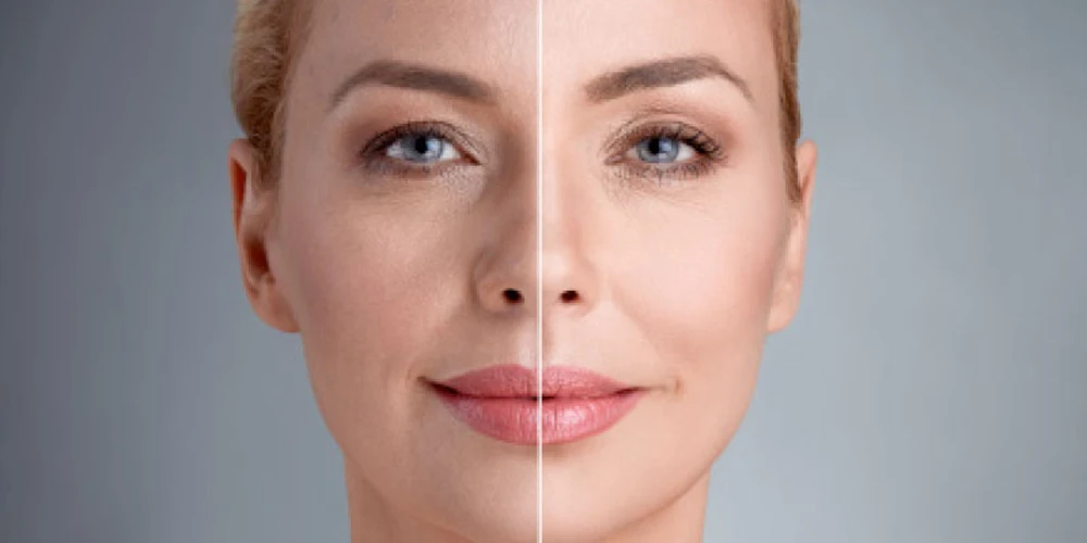 What is a Biostimulant? Collagen Vaccine Revolution in Skin Rejuvenation