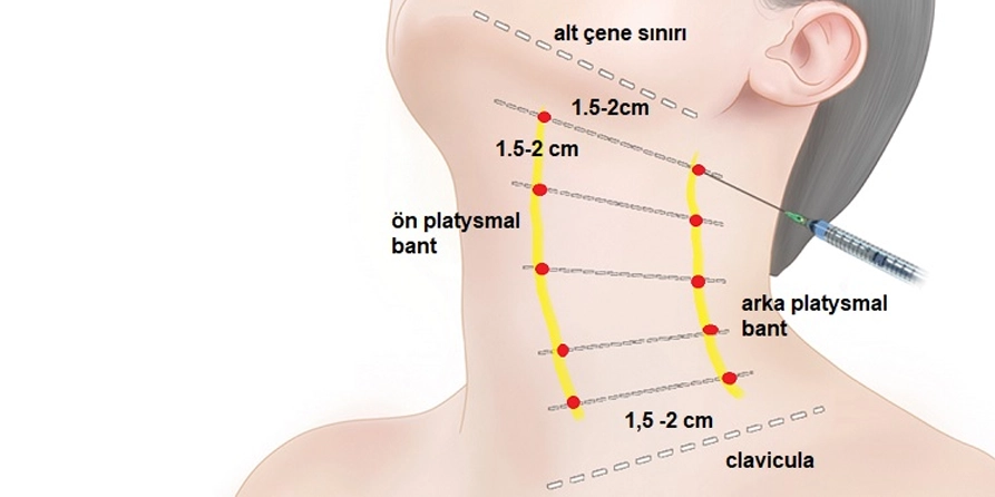 Boyun Botoksu | Nefertiti Lift &Amp; Boyun Çizgileri | Medlook