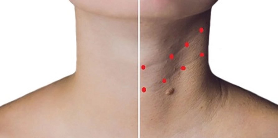 Boyun Botoksu | Nefertiti Lift &Amp; Boyun Çizgileri | Medlook