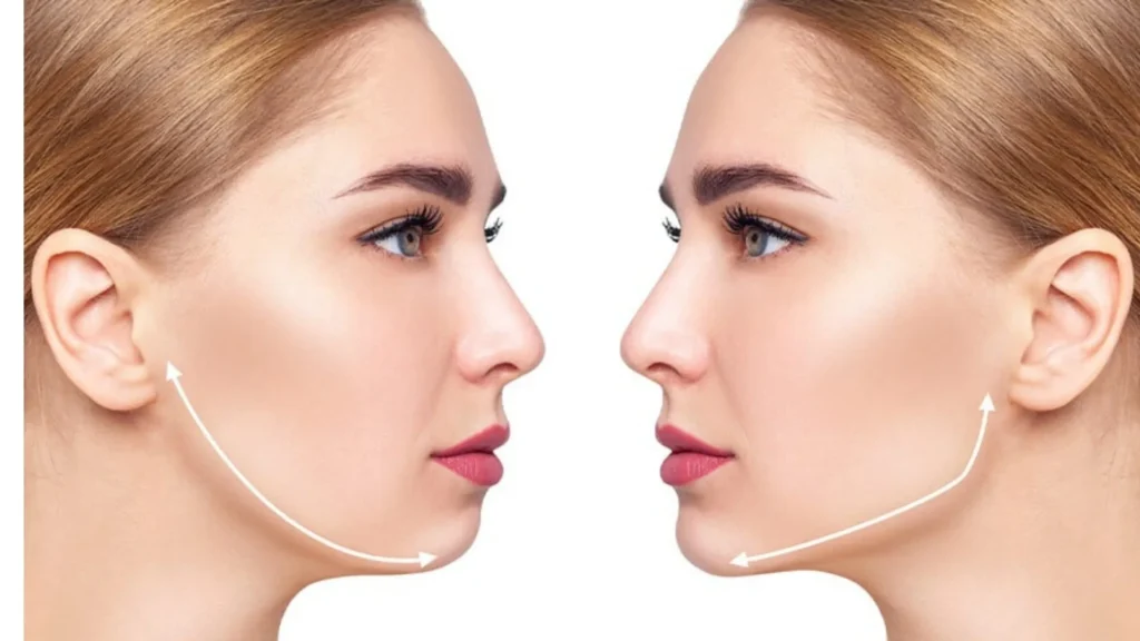 Jawline Nedir - Özel Medlook Polikliniği Jawline Nedir? Çene Hattı Estetiği 2026 Rehberi