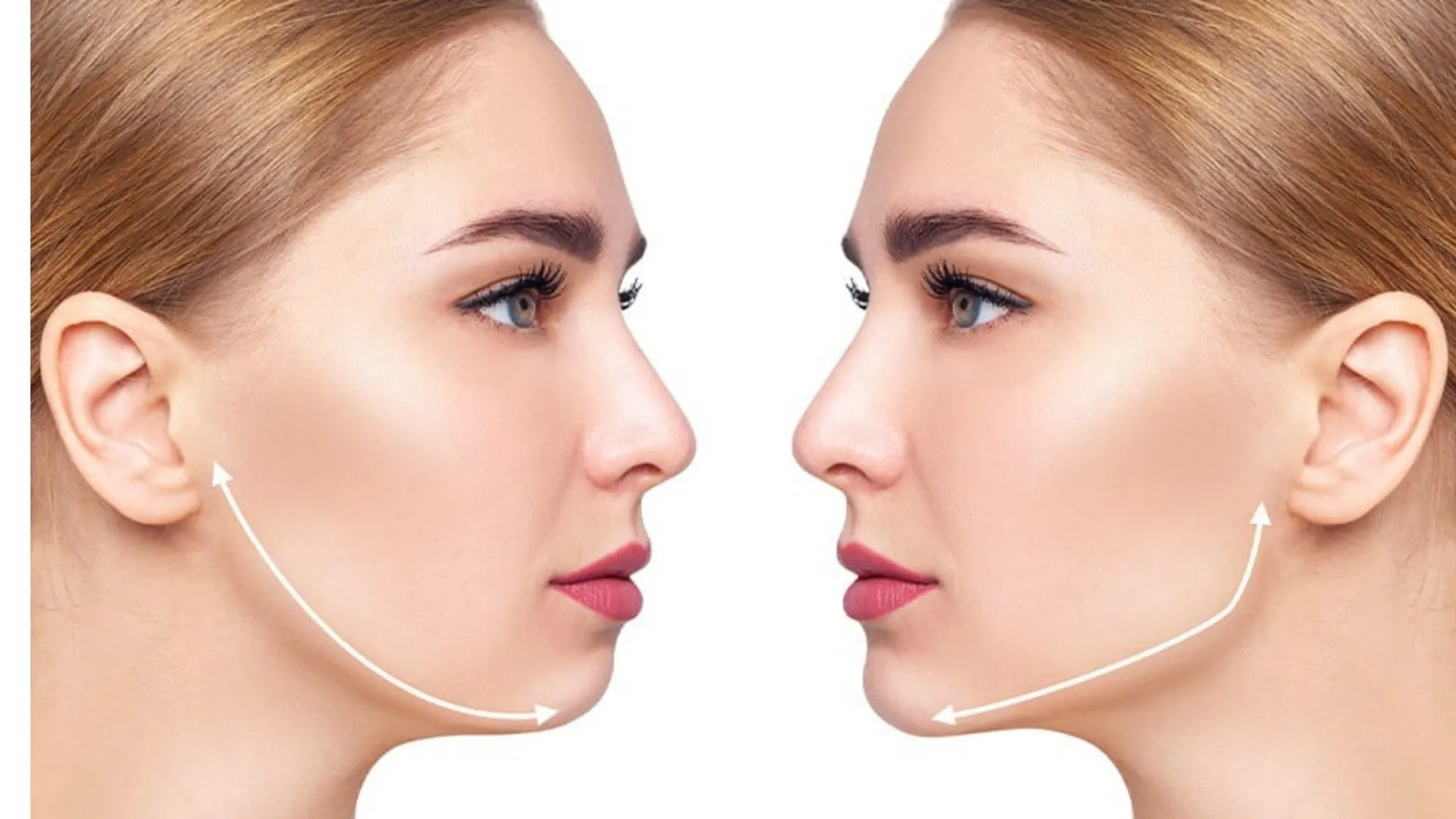 Jawline Nedir? Çene Hattı Estetiği 2026 Rehberi
